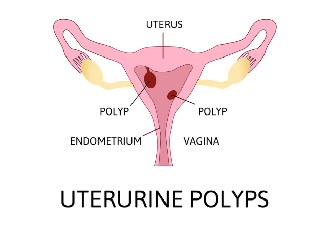 uterus polyps