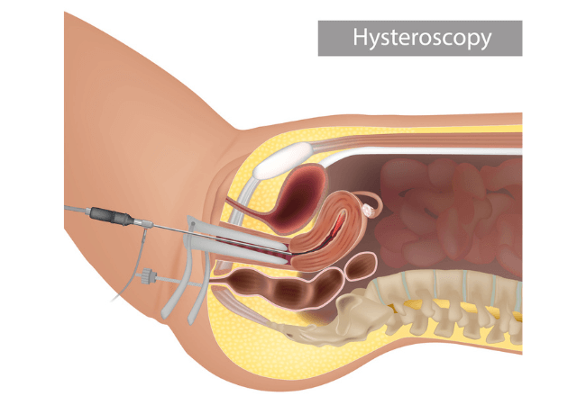 Hysteroscopy