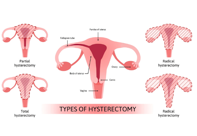 Hysterectomy